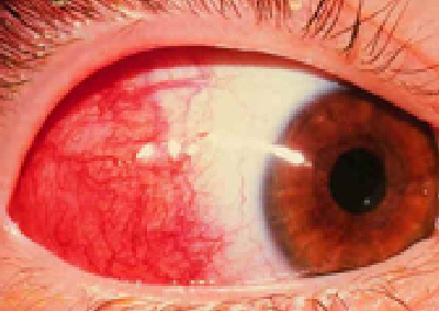 希瑪林順潮眼科中心_眼角膜疾病_單純性表層鞏膜炎