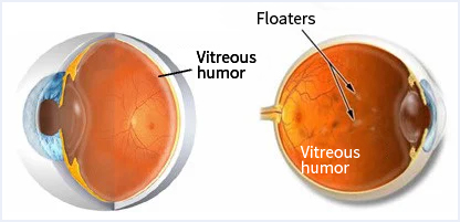  CMER Eye Center_ eye floaters _ Malignant floaters