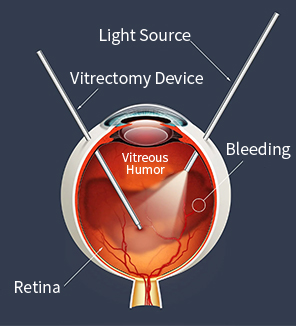 CMER Eye Center_ eye floaters treatment 1