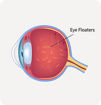 CMER Eye Center_ eye floaters treatment 1
