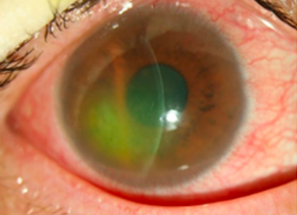 希瑪林順潮眼科中心_眼角膜疾病_眼角膜破損症狀